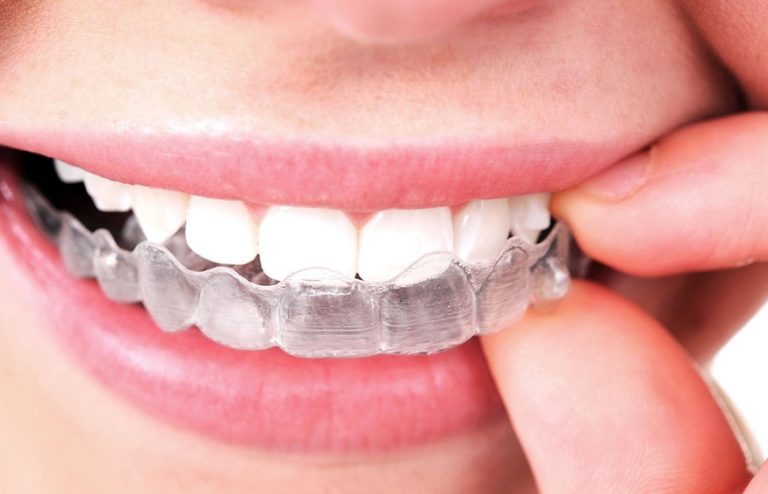 Find out how to rework your smile with makeO toothsi aligners